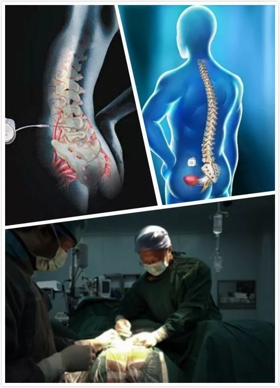 河北燕达医院泌尿外科：3D打印技术“助攻”骶神经调控术